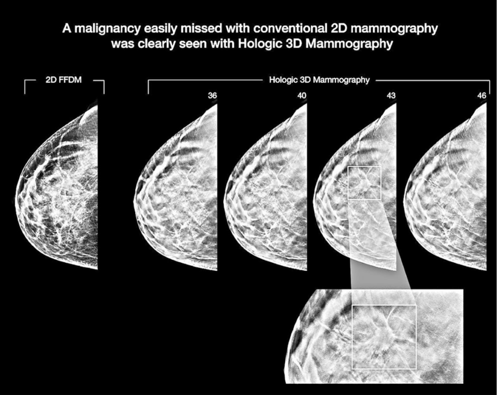 Mammograms Are Better In 3D – Family Medicine Center